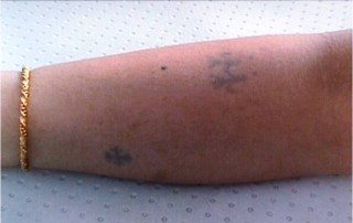 tattoo removal before treatment