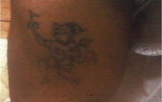 tattoo removal after treatment