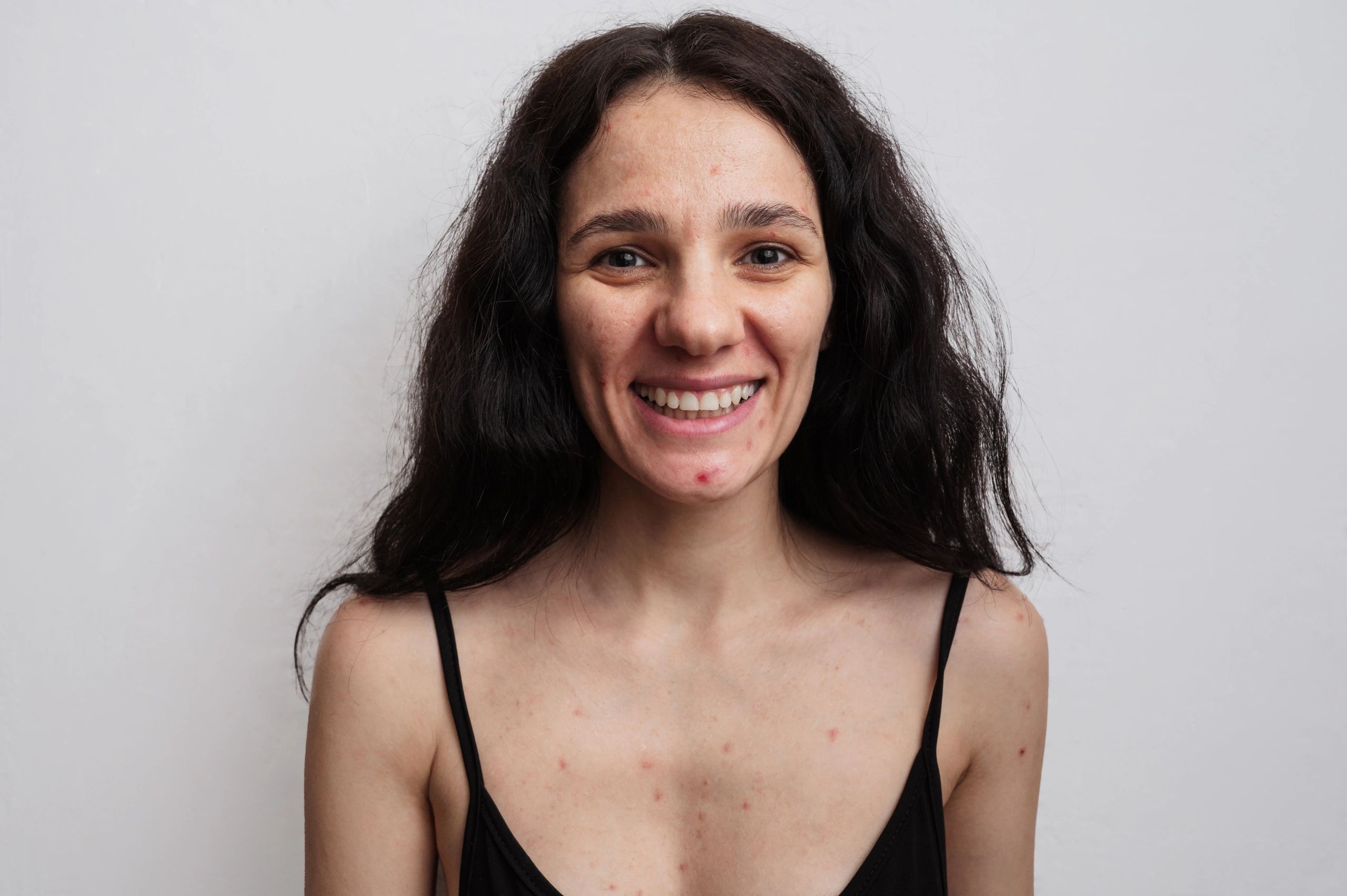 happy dermatology patient testimonial