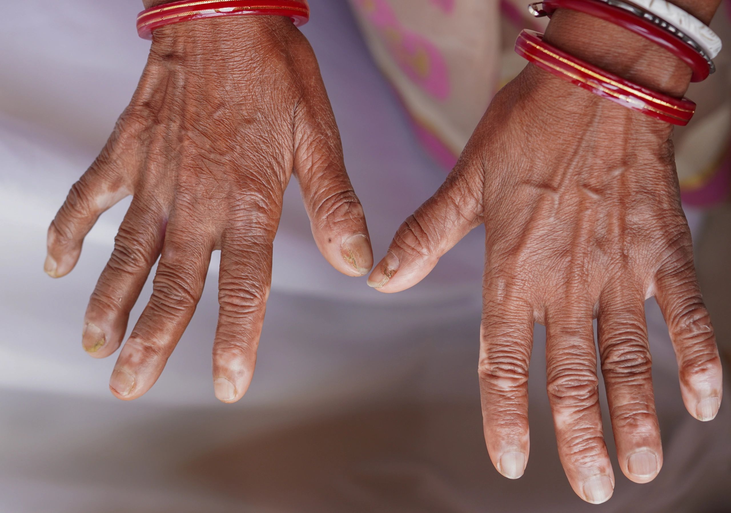 skin pigmentation treatment