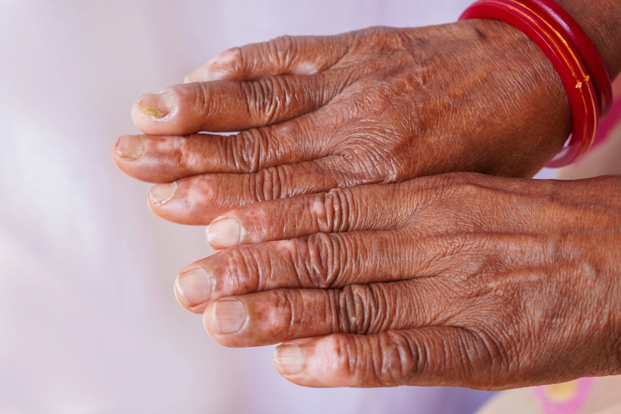 skin pigmentation treatment
